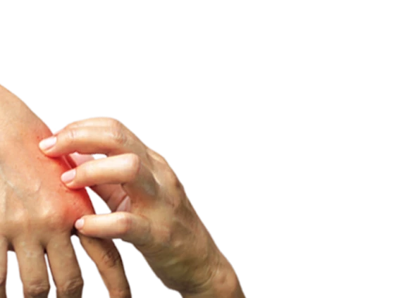 Eine Hand kratzt die Andere mit roten Stellen