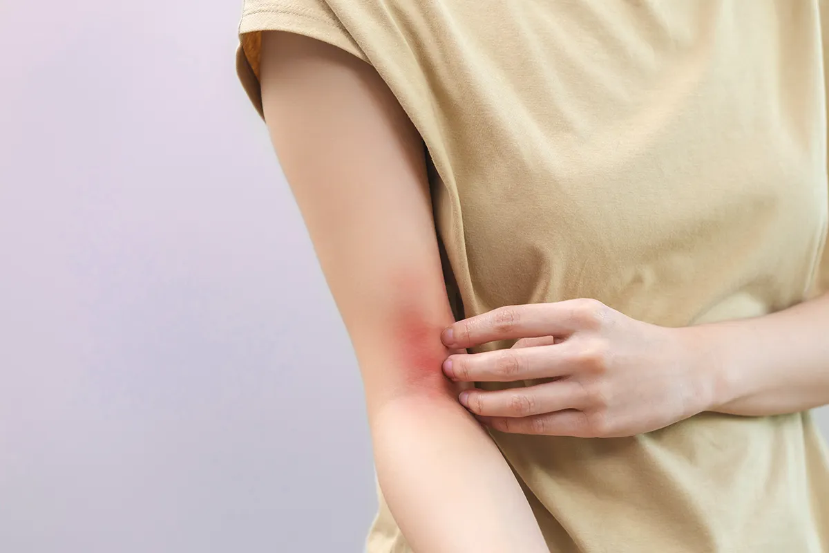 Eine weibliche Person mit einer rechten stark geröteten Ellebogenbeuge